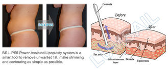 máquina quirúrgica del Liposuction 300W para el Liposuction trasero superior e inferior
